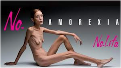 donna anoressivca