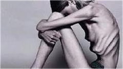 donna fortemente anoressica